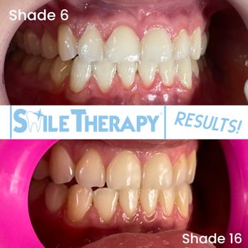 Smile Therapy - Teeth Whitening Near Me - Clovis , California Smile Therapy - Teeth Whitening Near Me - Clovis , California