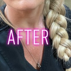 Indulgence Medical Day Spa - Lips after fillers