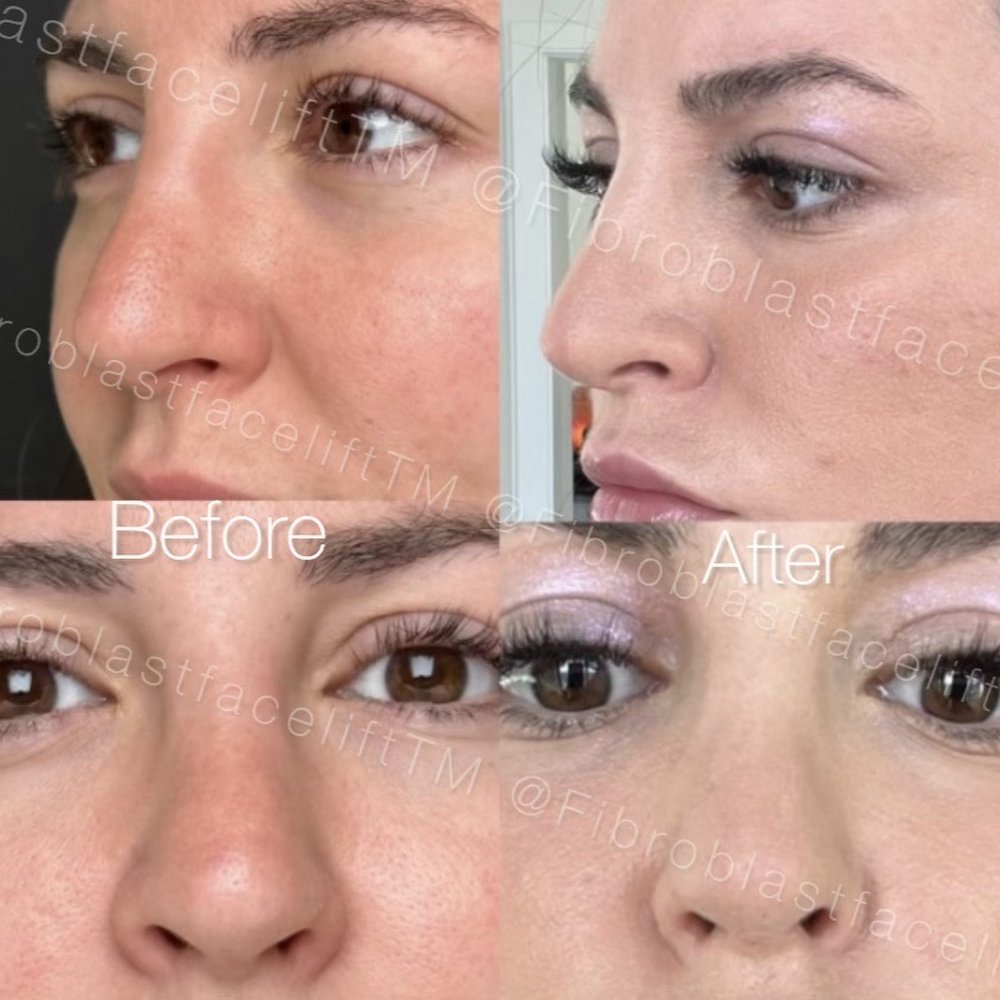 Fibroblast facelift results by Rochelle