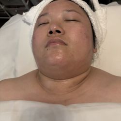 Esthetics by Irene - After Hydrojelly treatment