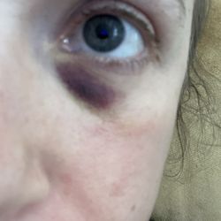Luna Aesthetics Skin Care Center - Bruising from Botox