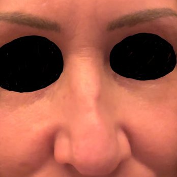 John Minoli MD FACS Las Vegas Cosmetic Surgery - Frontal veiw at one year. Yes, I had to walk around like that. - Cosmetic Surgeons Near Me - Las Vegas, Nevada John Minoli MD FACS Las Vegas Cosmetic Surgery - Frontal veiw at one year. Yes, I had to walk around like that. - Cosmetic Surgeons Near Me - Las Vegas, Nevada