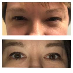 Vitality Health & Wellness - Plasma pen upper lid non surgical blepharoplasty!