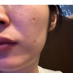 South Coast MedSpa - After the 6th laser treatment with just prp (with makeup).