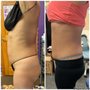 Photo of BodyContouring by J