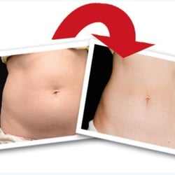 Precision M.D. Cosmetic Surgery Center - Before & After Coolsculpting treatment