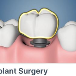 Oral Surgery Associates - Https://myoms.org/procedures/does-insurance-cover-dental-implants