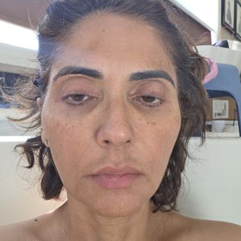 Zavant Aesthetics - Unable to fully open my eyelids. - Laser Hair Removal Near Me - West Hollywood, California