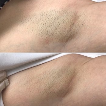 Venus Waxing Spa - After 1st laser treatment - Laser Hair Removal Near Me - Miami, Florida