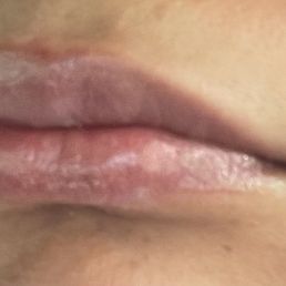 After lip filler procedure, no bruising just swollen . I didn't feel pain .