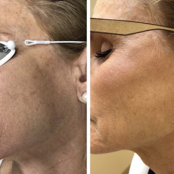 Geria Dermatology - Rutherford - Before and after IPL treatment for sun spots - Dermatologists Near Me - Rutherford, New Jersey