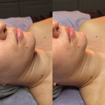 Wonderland Spa - Neck lift - non invasive - Skin Care Near Me - Phoenix, Arizona Wonderland Spa - Neck lift - non invasive - Skin Care Near Me - Phoenix, Arizona