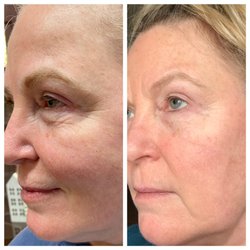 Layered Esthetics - Peptide Face lift