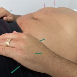 Culver Spine & Wellness - Acupuncture treatment