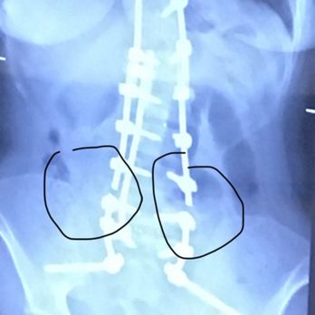 Ian G. Dorward, MD - Broken hardware - Spine Surgeons Near Me - St. Louis, Missouri Ian G. Dorward, MD - Broken hardware - Spine Surgeons Near Me - St. Louis, Missouri