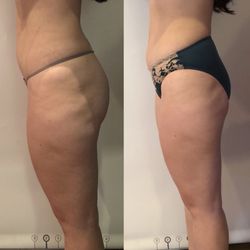 Red Carpet On Queen - Before and after only 3 sections with lipomassage to target fat and cellulite