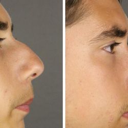 David A Newman, MD FACS -  Newman Temecula Plastic Surgery - Rhinoplasty before and after.
