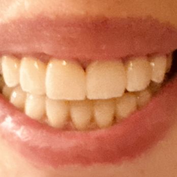 Modern Dental Studio - My new porcelain veneers - Periodontists Near Me - East Brunswick, New Jersey Modern Dental Studio - My new porcelain veneers - Periodontists Near Me - East Brunswick, New Jersey