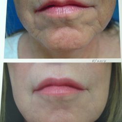 Frontier Dermatology Aesthetics - Before after