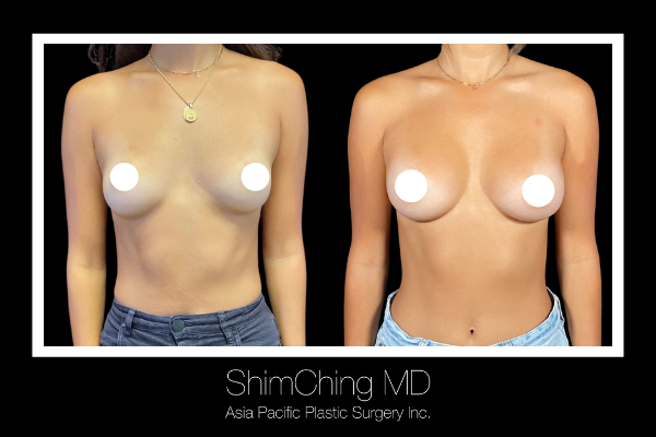 Scarless Breast Augmentation - By creating a scar hidden in the wrinkles of the armpit, Dr. Ching is able to augment the breasts with a scar that is practically invisible.