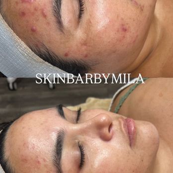 Skin Bar by Mila - This progress photo was taken only two months apart and my skin has cleared up even more since then - Skin Care Near Me - Long Beach, California Skin Bar by Mila - This progress photo was taken only two months apart and my skin has cleared up even more since then - Skin Care Near Me - Long Beach, California