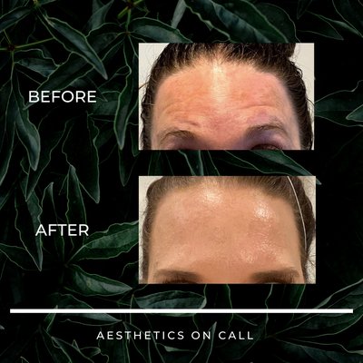 Botox/Dysport/Xeomin Before and Afters - Book today to get results like these! Botox/Dysport/Xeomin Before and Afters - Book today to get results like these!