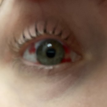 LasikPlus - Here you can see the red spots (bruises) on my eyes. Again, did not hurt at all. Just looked crazy. - Optometrists Near Me - Chicago, Illinois