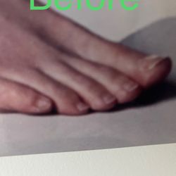 Martha Holzworth, DPM-Stride Forward Medical Group - My feet before surgery
