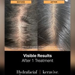 Hush Aesthetics - Keravive Hydrafacial Hair Rejuvenation