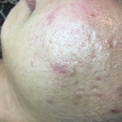 Leeann's Skin and Laser Center - Beginning of Microneedling treatment - some acne scarring