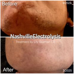 Nashville Electrolysis - Coarse, curly hair? No problem. Electrolysis is a safe and effective permanent solution for people of color. Treatment by Lily.