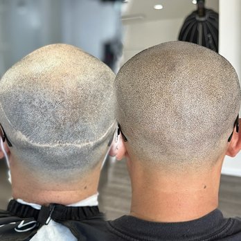 Scalp Micropigmentation Academy - Fut scar camouflaging with smp - Hair Loss Centers Near Me - San Lorenzo, California Scalp Micropigmentation Academy - Fut scar camouflaging with smp - Hair Loss Centers Near Me - San Lorenzo, California