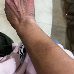 Washoe County Sheriff's Office - One of many pics of bruises.