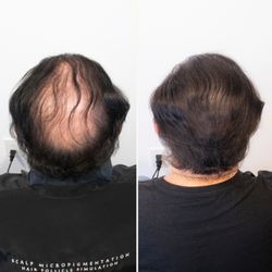 Unyozi Beauty - Density on the crown post Hair Transplant