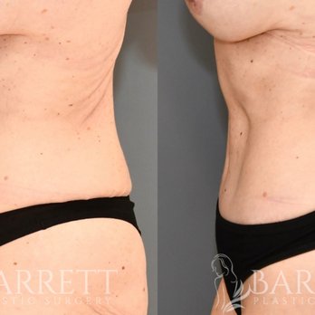 Alex Neusner, MD - 4-month tummy tuck result showcasing a flatter, more defined abdomen and beautifully refined waistline. - Plastic Surgeons Near Me - Beverly Hills, California Alex Neusner, MD - 4-month tummy tuck result showcasing a flatter, more defined abdomen and beautifully refined waistline. - Plastic Surgeons Near Me - Beverly Hills, California
