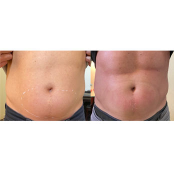 Nozawa Intl - Cool Tummy Sculpt + EM Sculpt (after one time) - Skin Care Near Me