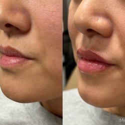 Bespoke Medesthetics - Natural lip filler w nurse Melanie - bespoke Medesthetics, Jericho ny