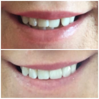 Bright Now! Dental & Orthodontics - Before and after - General Dentistry Near Me - Indio, California