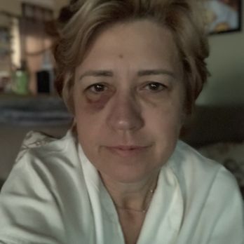 Advanced SkinCare - 3 days after - Medical Spas Near Me - Fullerton, California