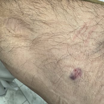 Quest Diagnostics - Bruise!! - Laboratory Testing Near Me - Boerne, Texas Quest Diagnostics - Bruise!! - Laboratory Testing Near Me - Boerne, Texas
