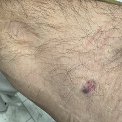 Quest Diagnostics - Bruise!!