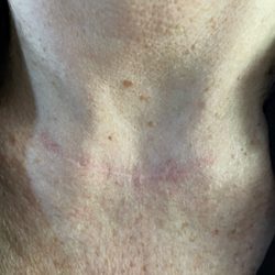 OC Skin Institute - A few weeks after aggressive skin cancer was removed