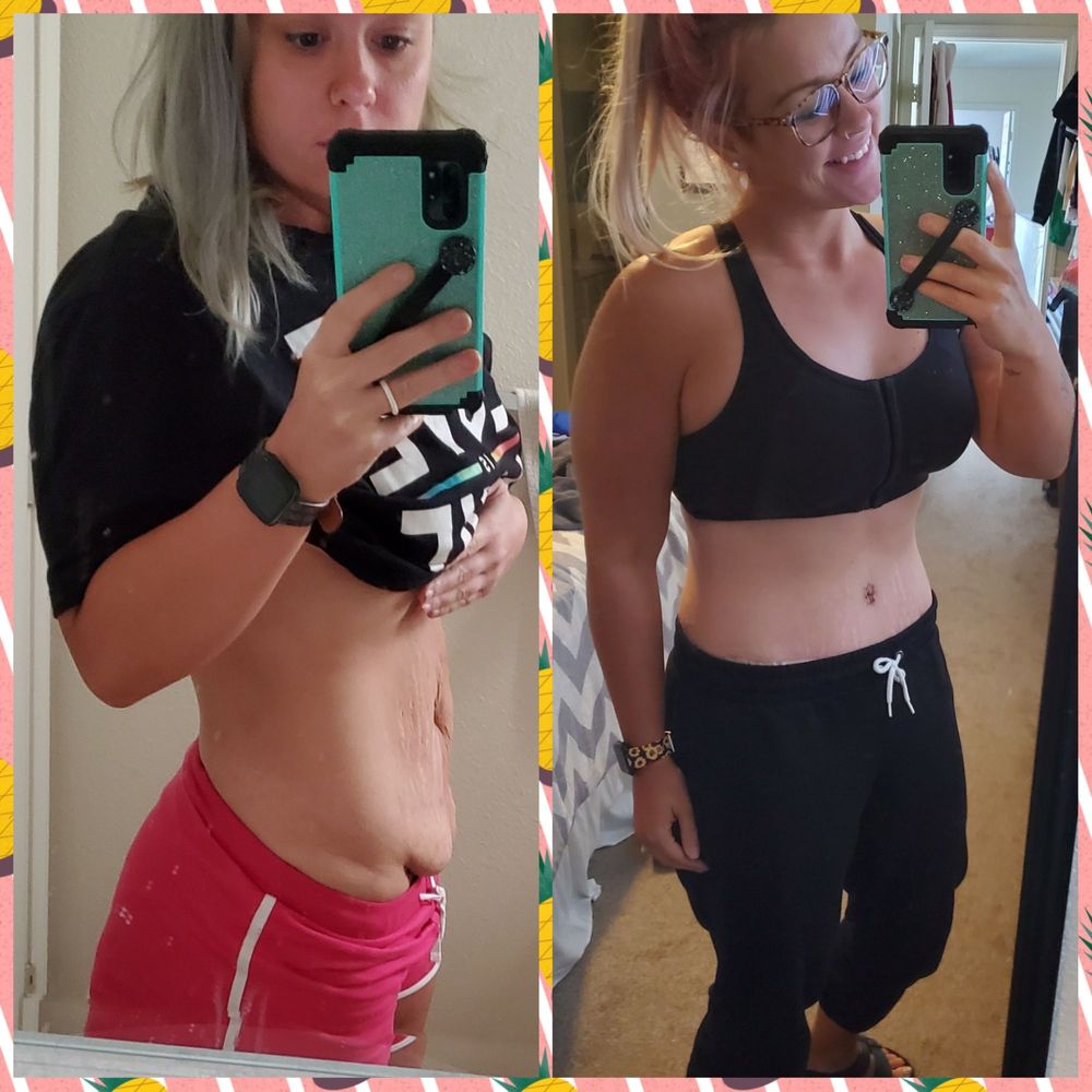 Iconic Plastic Surgery - Before and 11 days post surgery - Cosmetic Surgeons Near Me - Carlsbad, California Iconic Plastic Surgery - Before and 11 days post surgery - Cosmetic Surgeons Near Me - Carlsbad, California