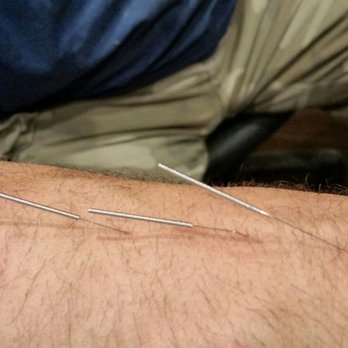 James Chung, DAOM, L.Ac - Here's a couple photos other procedure that dr. James Chung performed to take away the pain in my right wrist thanks again dr. Chung - Acupuncture Near Me - Pasadena, California James Chung, DAOM, L.Ac - Here's a couple photos other procedure that dr. James Chung performed to take away the pain in my right wrist thanks again dr. Chung - Acupuncture Near Me - Pasadena, California