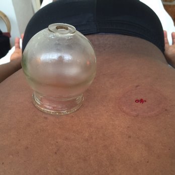 Haven Wellbeing - Cupping with bleeding for allergies or skin conditions - Acupuncture Near Me - Miami Beach, Florida