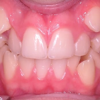 Wang Orthodontics - Wang Orthodontic Patient "A" Before - Orthodontists Near Me - Brick, New Jersey
