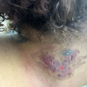 LaserAway - 2 days after treatment - Tattoo Removal Near Me - Fullerton, California