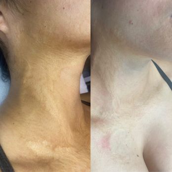 Kefi Aesthetics - skin tightening, scarring - Waxing Near Me - Avon, Connecticut Kefi Aesthetics - skin tightening, scarring - Waxing Near Me - Avon, Connecticut
