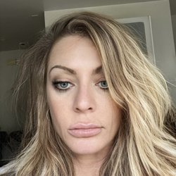 La Bella Cosmetic Surgery - Bad bottom lip implant done by Dr Dang.