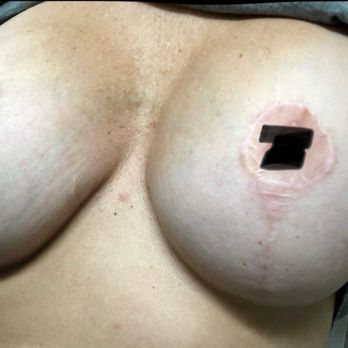 Chrysalis Cosmetics - Charles Perry, MD, FACS - Horrible work by this doctor - sloppy - Cosmetic Surgeons Near Me - Sacramento, California Chrysalis Cosmetics - Charles Perry, MD, FACS - Horrible work by this doctor - sloppy - Cosmetic Surgeons Near Me - Sacramento, California